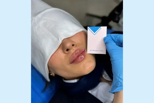 پروسه تزریق فیلر لب ایده آل